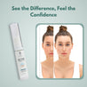 Acne Corrector Face Gel - Acne Minimizing Gel for Oily & Sensitive Skin - 10 ml - Rawls Essentials